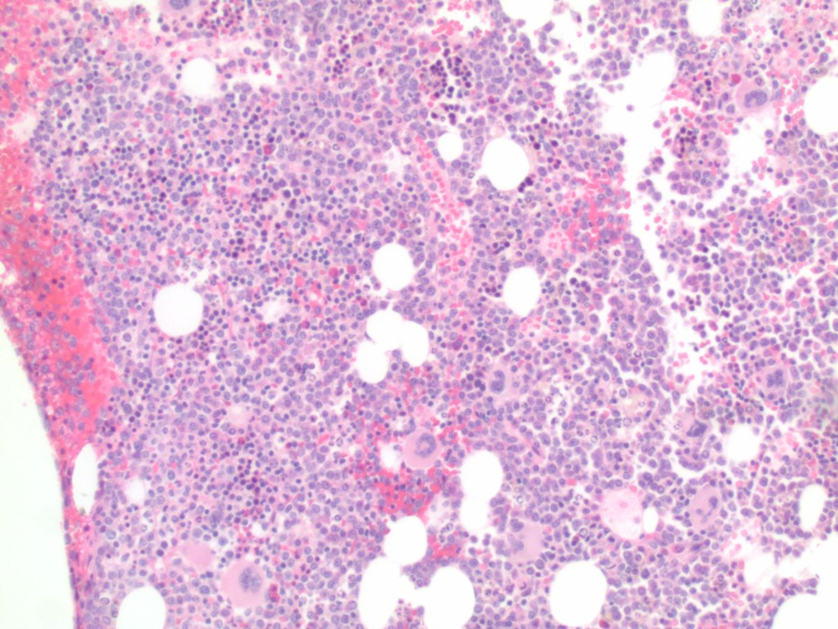 Initial core biopsy